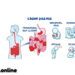 Crohn’s Disease: Causes, Symptoms, Treatment, and Ways to Manage It