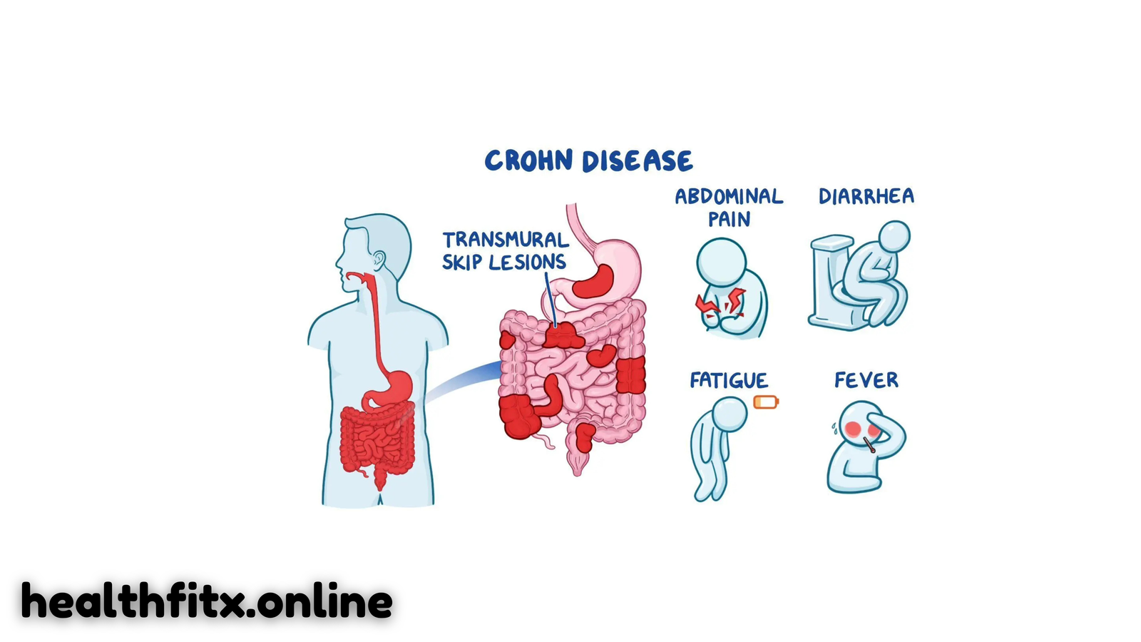 Crohn’s Disease: Causes, Symptoms, Treatment, and Ways to Manage It